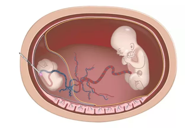 移植的多个胚胎都存活了，是否需要进行减胎手术？